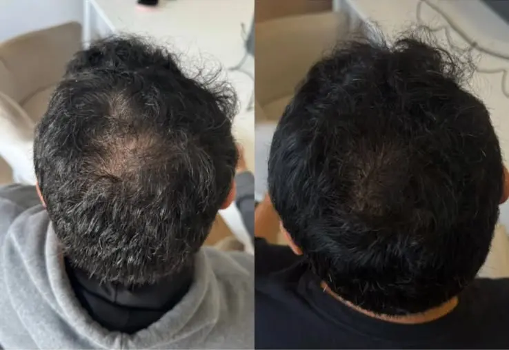 Acompanhamento de calvície masculina após 90 dias